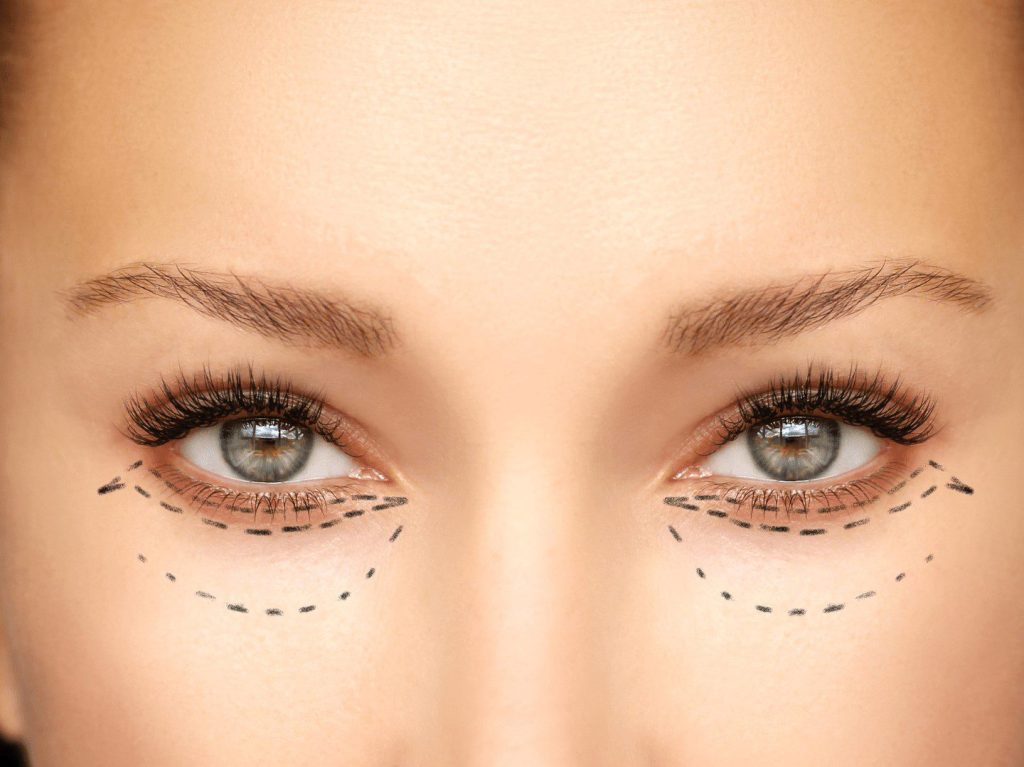 Plastyka powiek rekonwalescencja