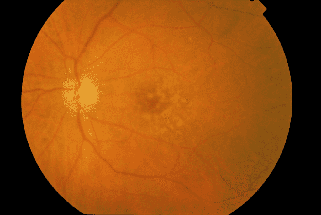 uszkodzenia siatkówki oka objawy 