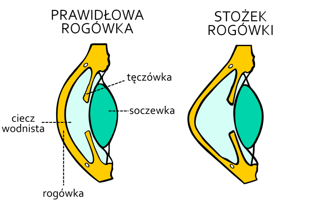 stożek rogówki