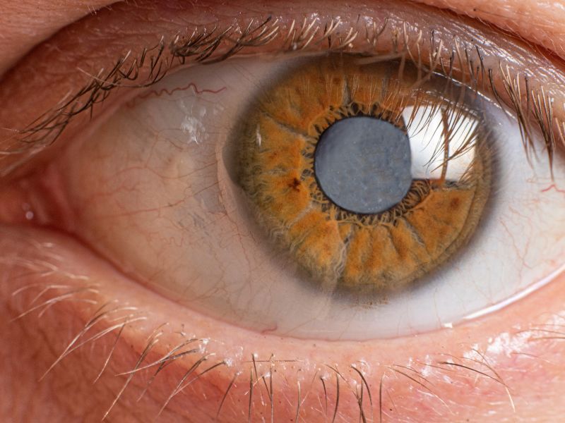 Odwarstwienie siatkówki oka