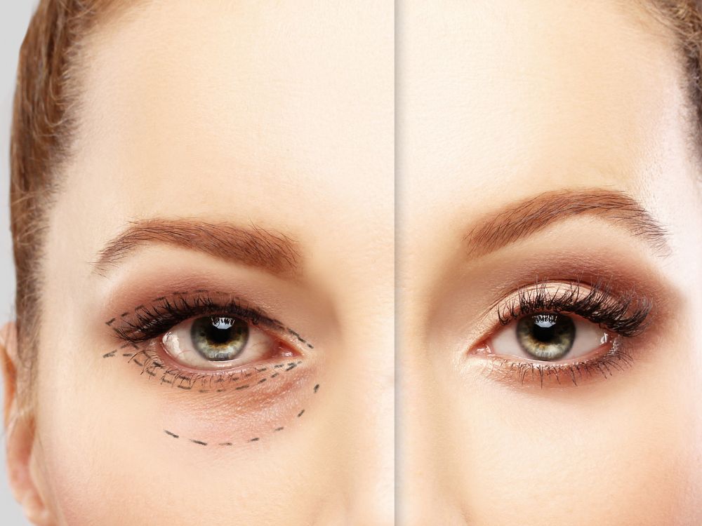 Jak wygląda opadająca powieka?